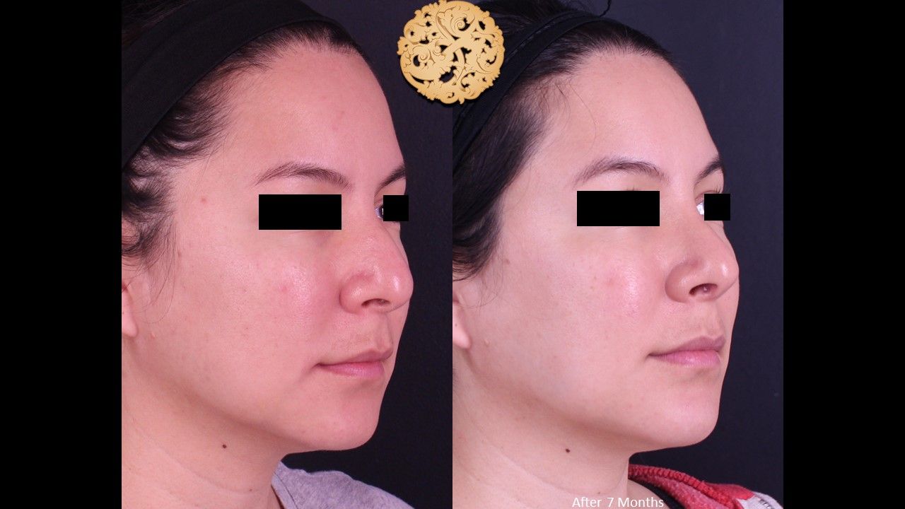 Rhinoplasty Before & After