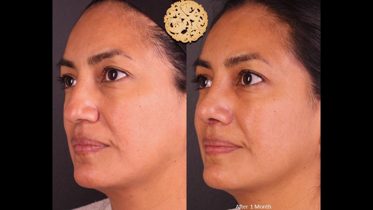 Rhinoplasty Before & After