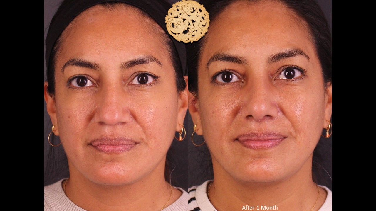 Rhinoplasty Before & After