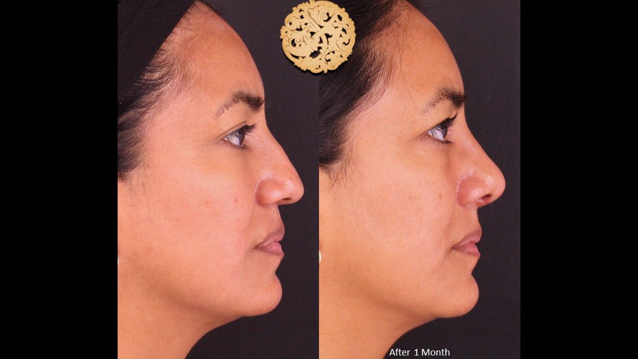 Rhinoplasty Before & After