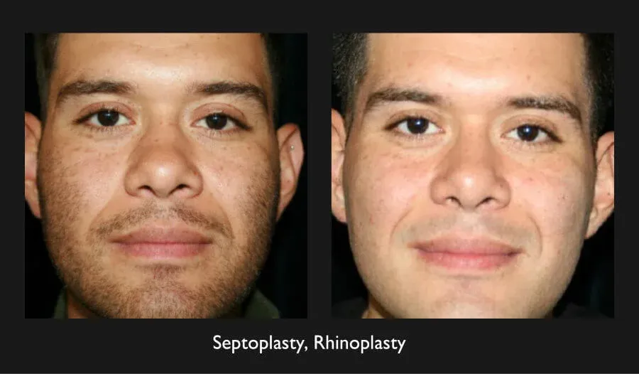 Rhinoplasty Before & After