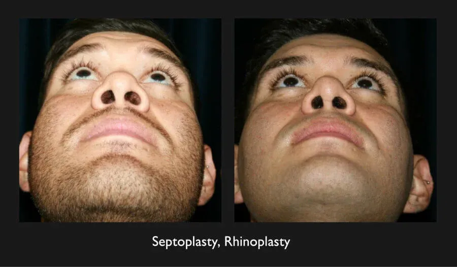Rhinoplasty Before & After