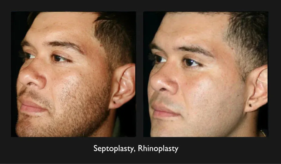 Rhinoplasty Before & After