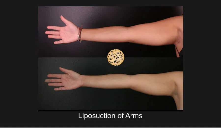 Liposuction Before & After