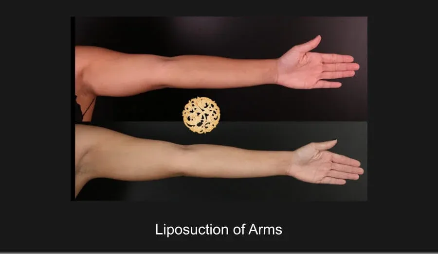 Liposuction Before & After