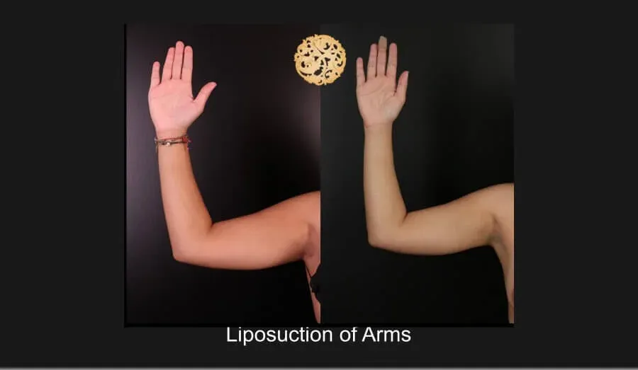 Liposuction Before & After