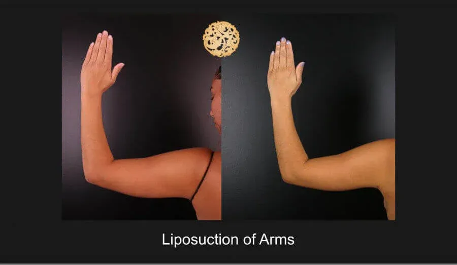 Liposuction Before & After