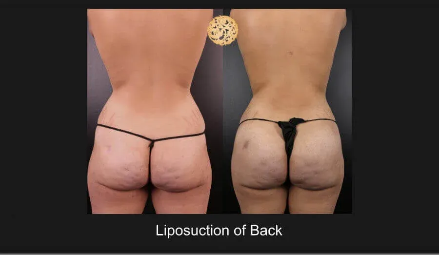 Liposuction Before & After