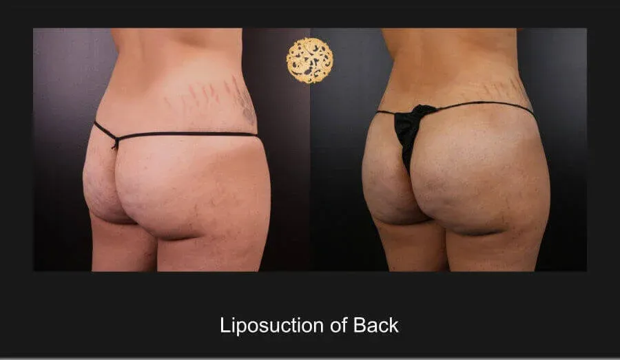 Liposuction Before & After