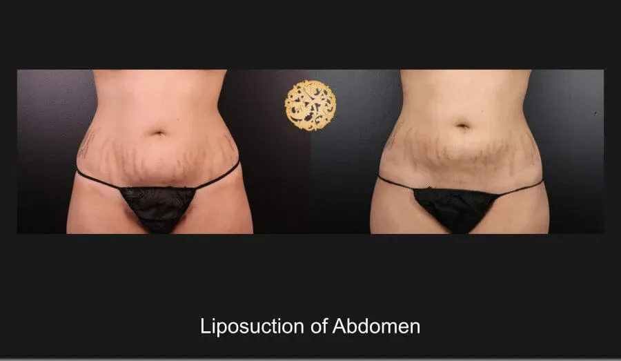Liposuction Before & After