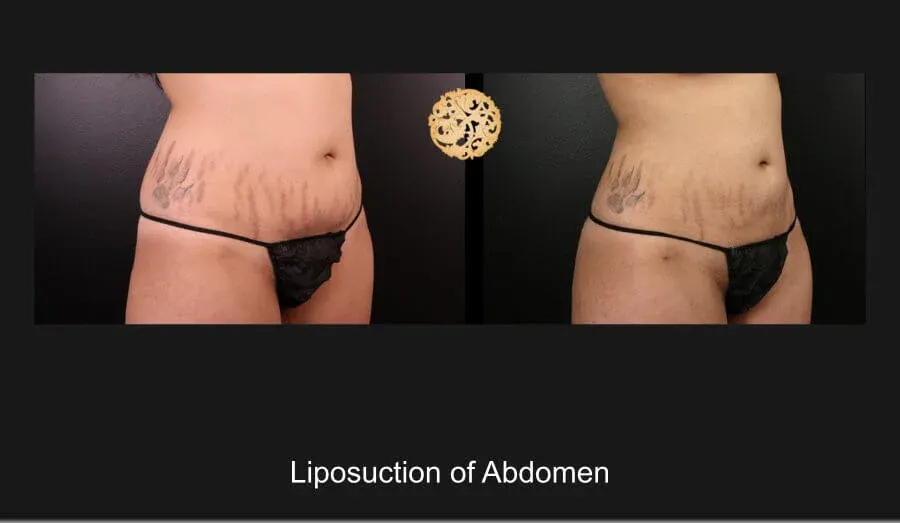 Liposuction Before & After