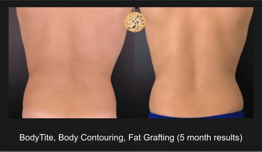 Liposuction Before & After