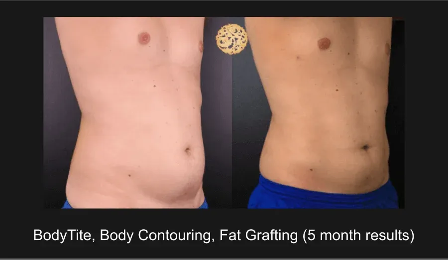 Liposuction Before & After