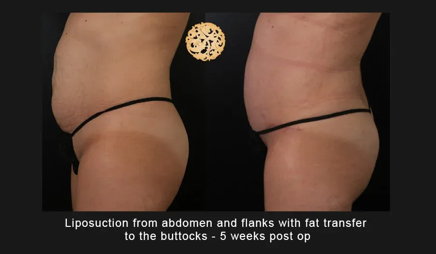 Liposuction Before & After