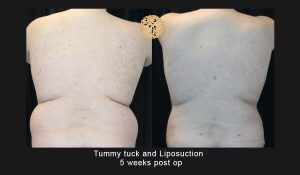Liposuction Before & After