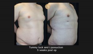 Liposuction Before & After