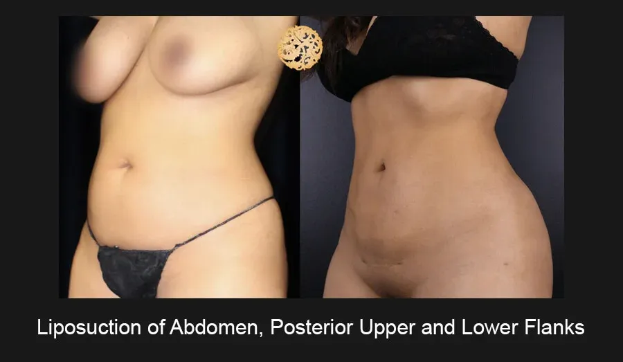 Liposuction Before & After