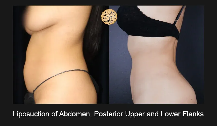Liposuction Before & After