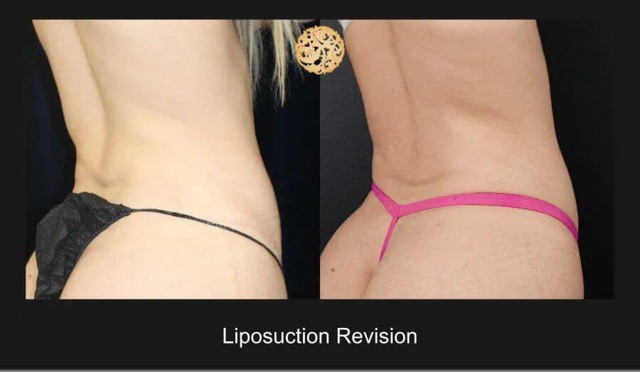 Liposuction Before & After