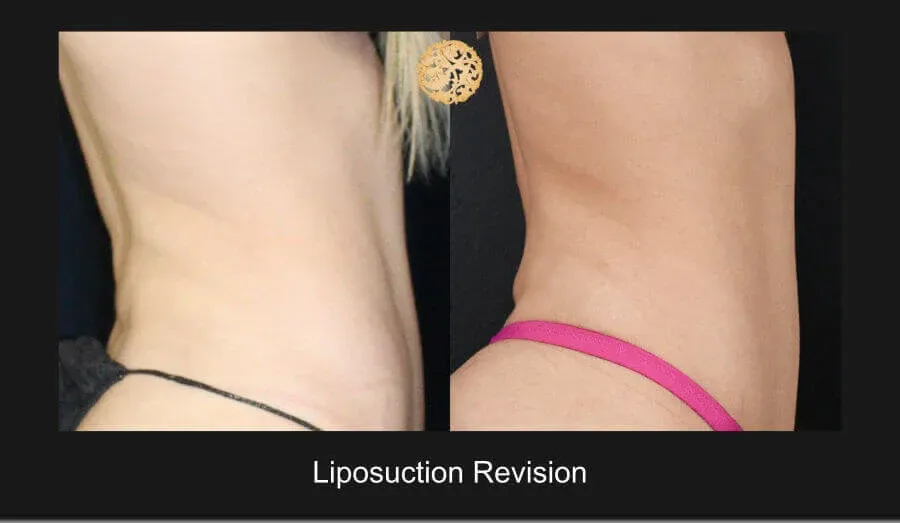 Liposuction Before & After
