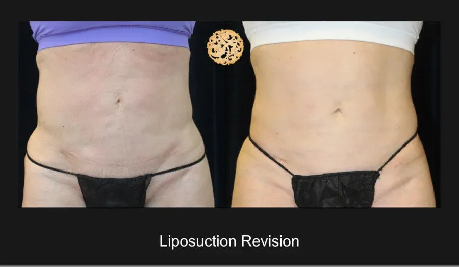 Liposuction Before & After