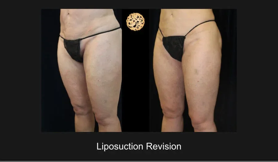 Liposuction Before & After
