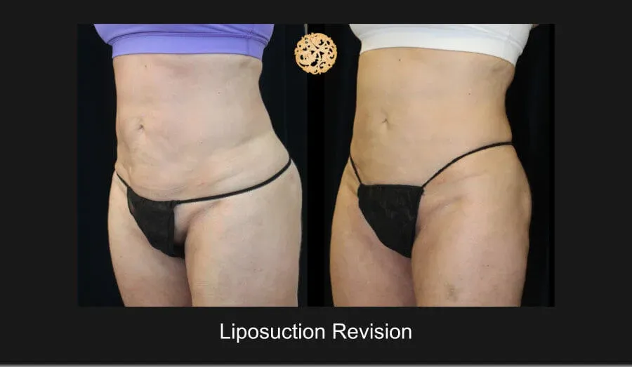 Liposuction Before & After