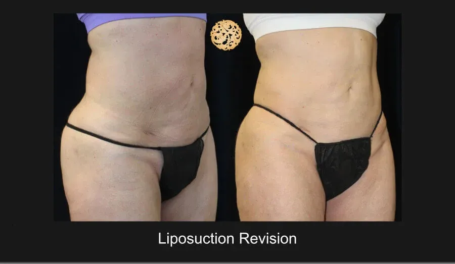 Liposuction Before & After