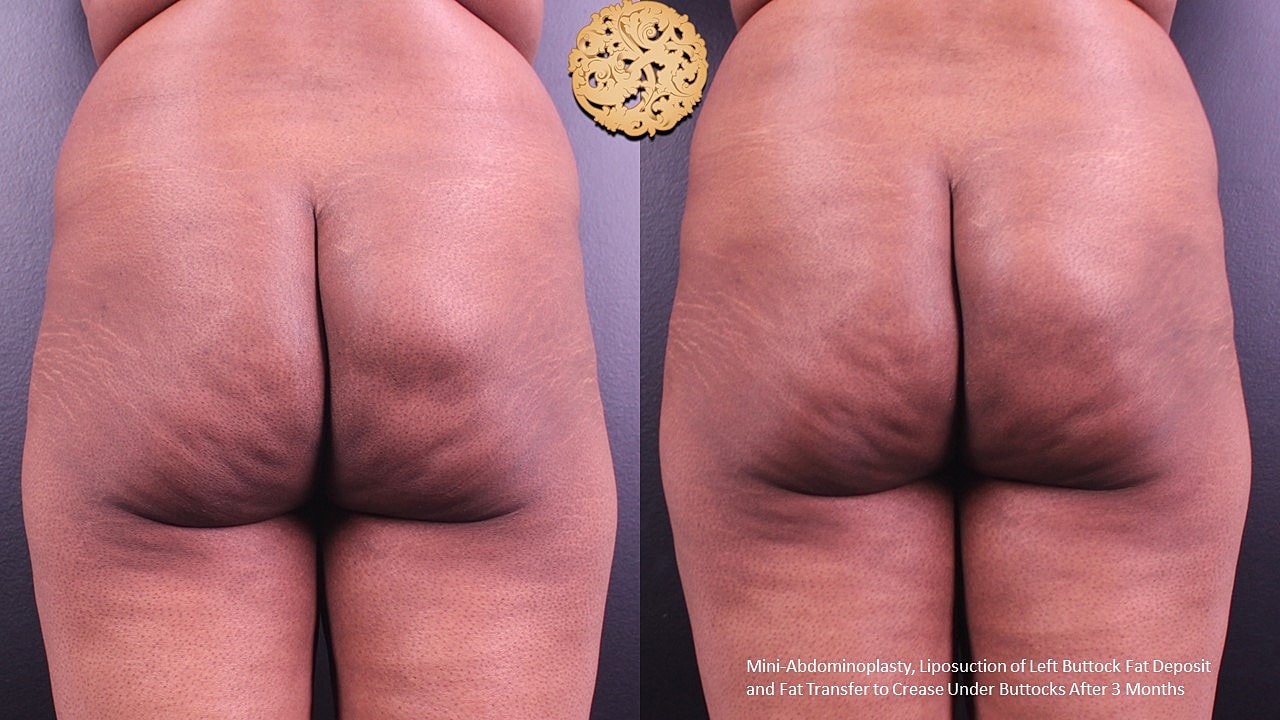 Liposuction Before & After