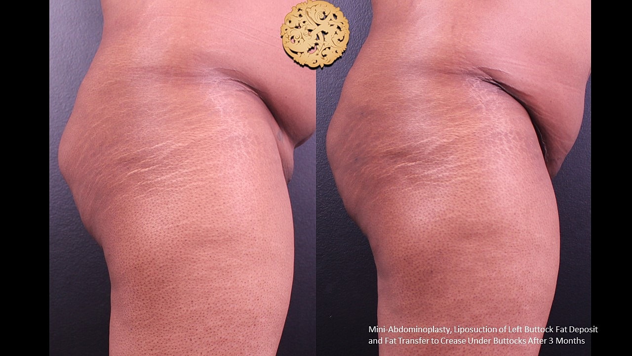 Liposuction Before & After