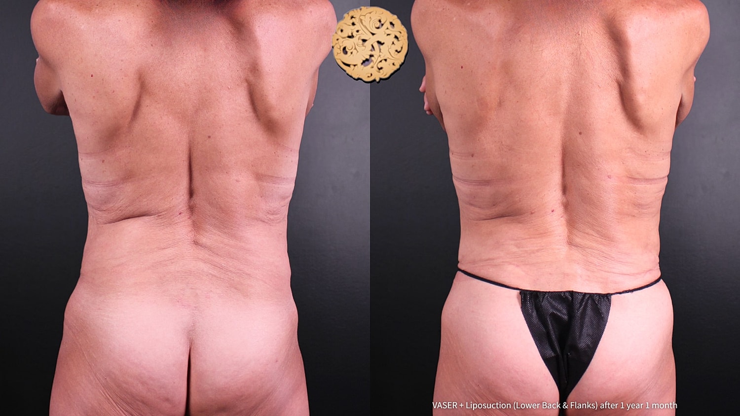 Liposuction Before & After