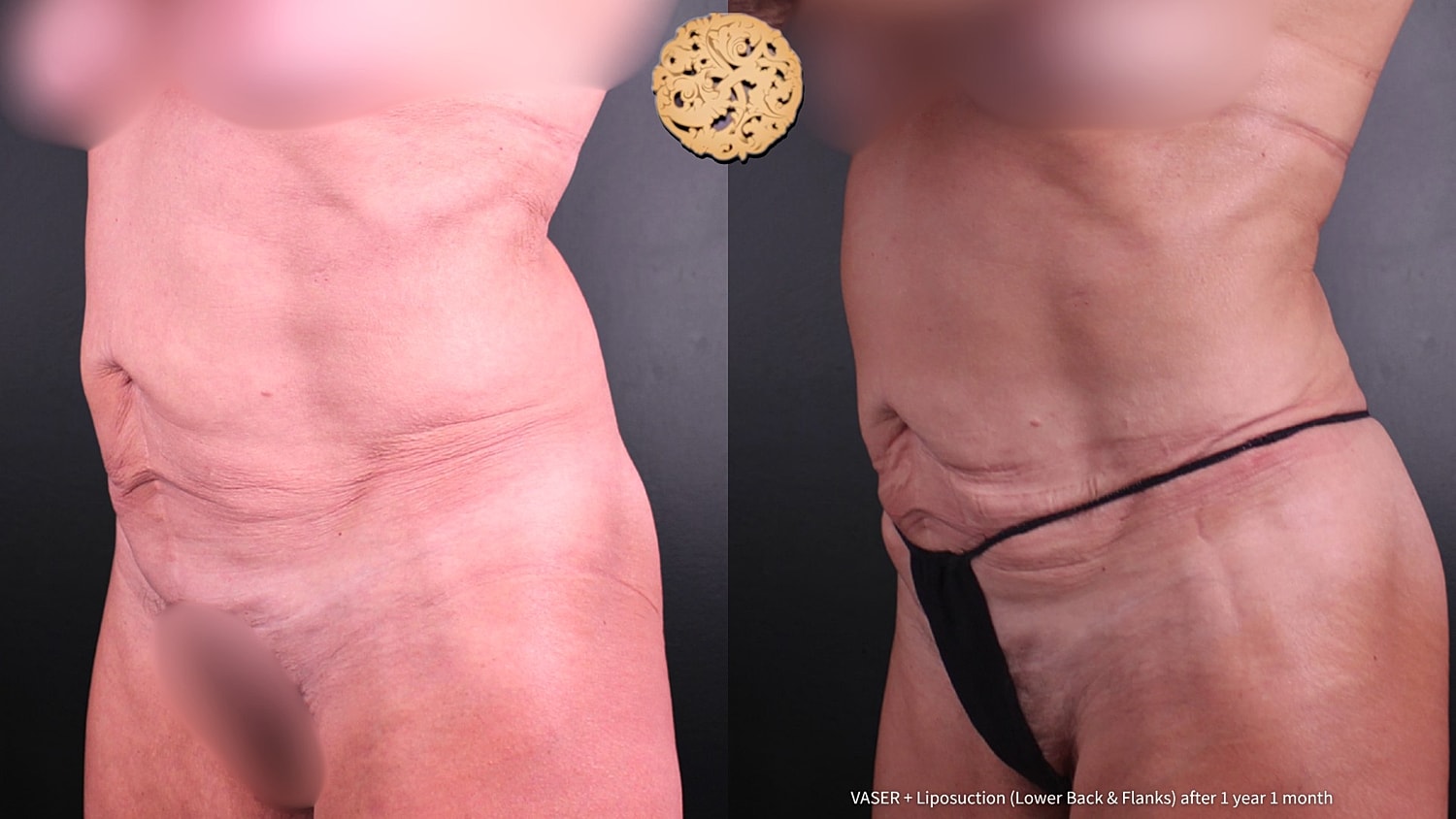 Liposuction Before & After