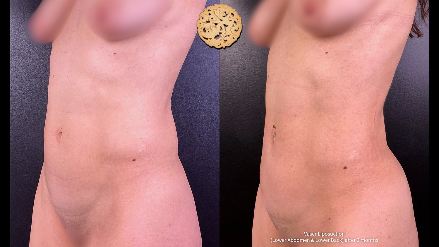 Liposuction Before & After