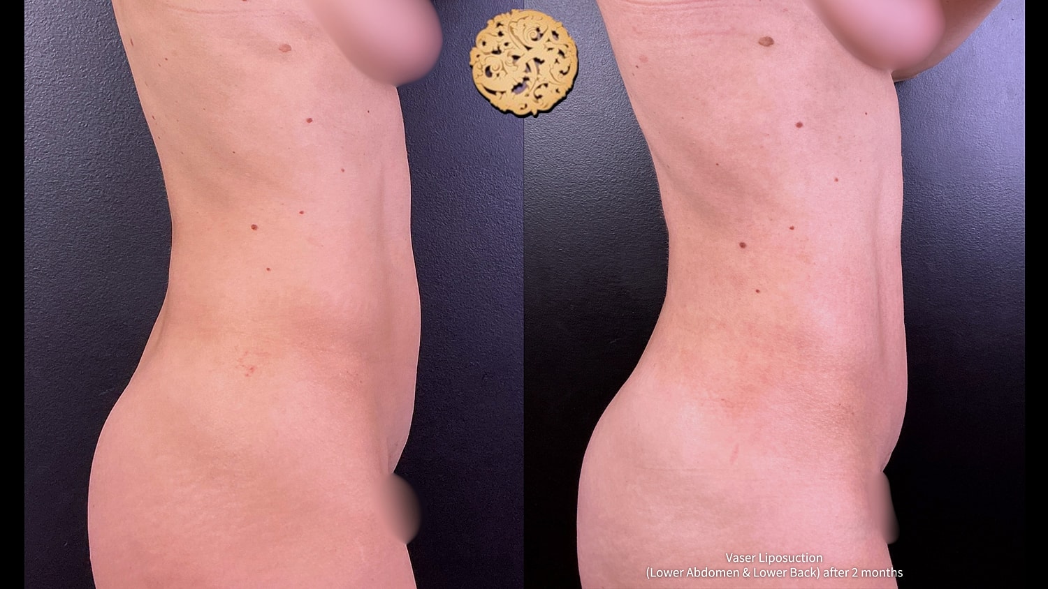 Liposuction Before & After