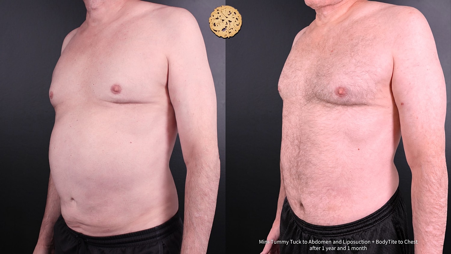 Liposuction Before & After