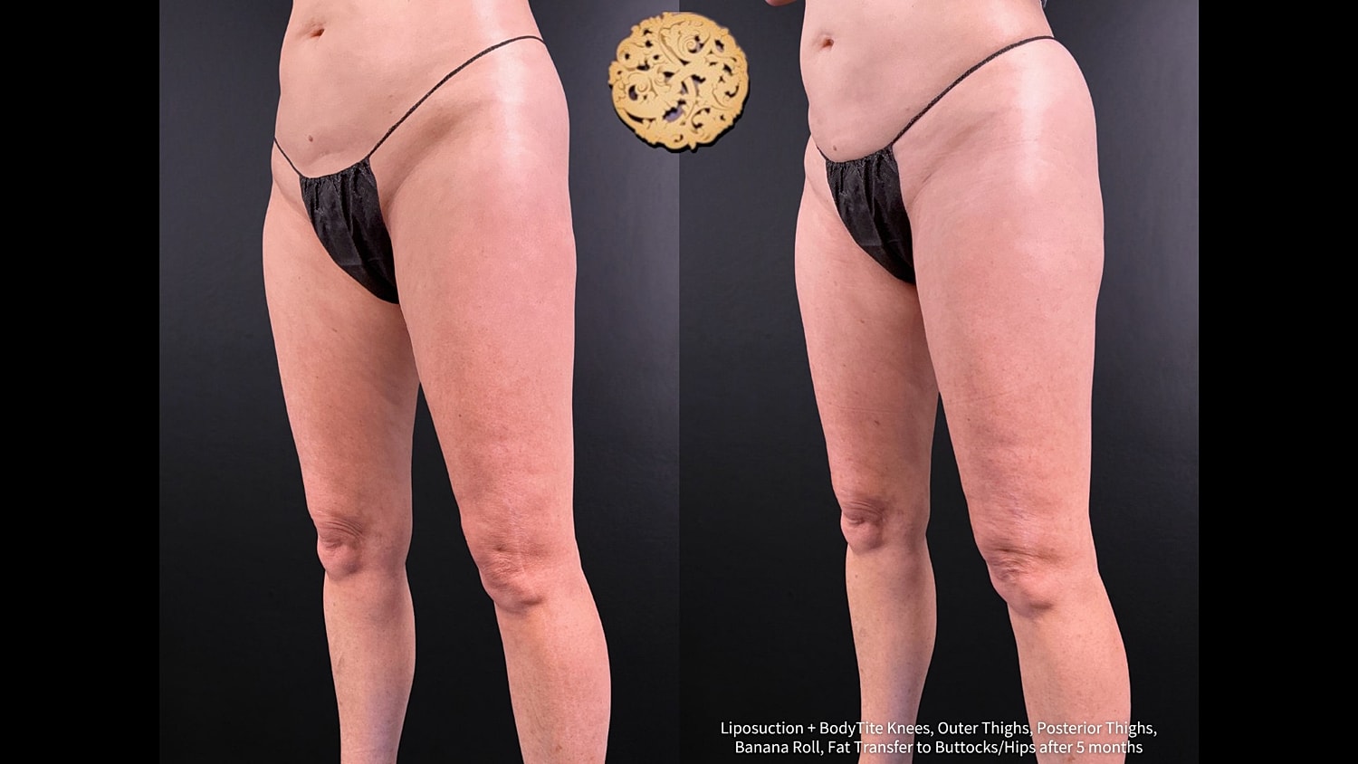 Liposuction Before & After