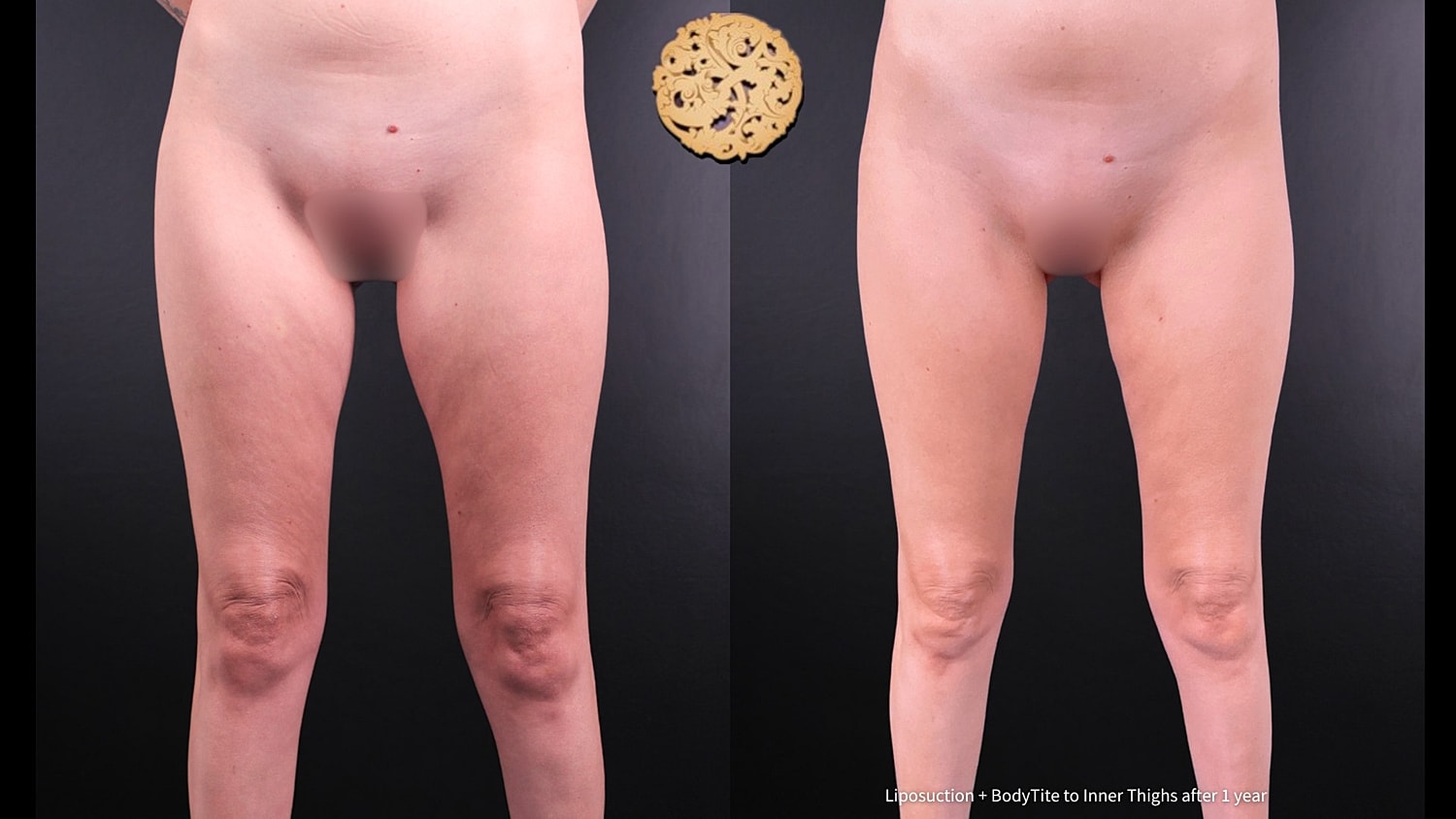 Liposuction Before & After