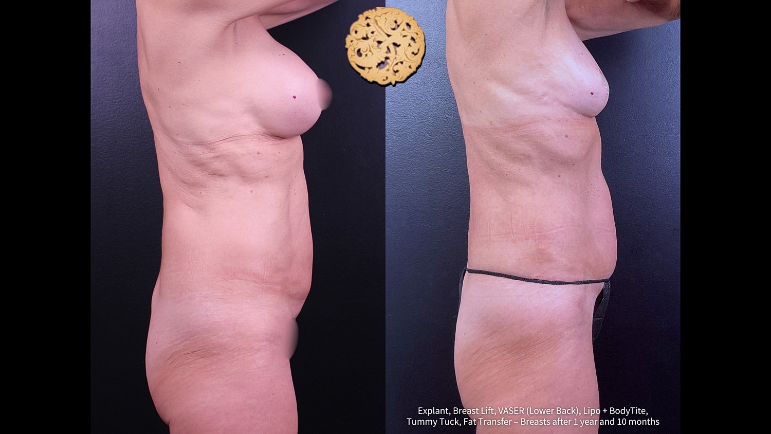 Liposuction Before & After