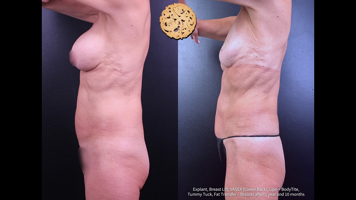 Liposuction Before & After