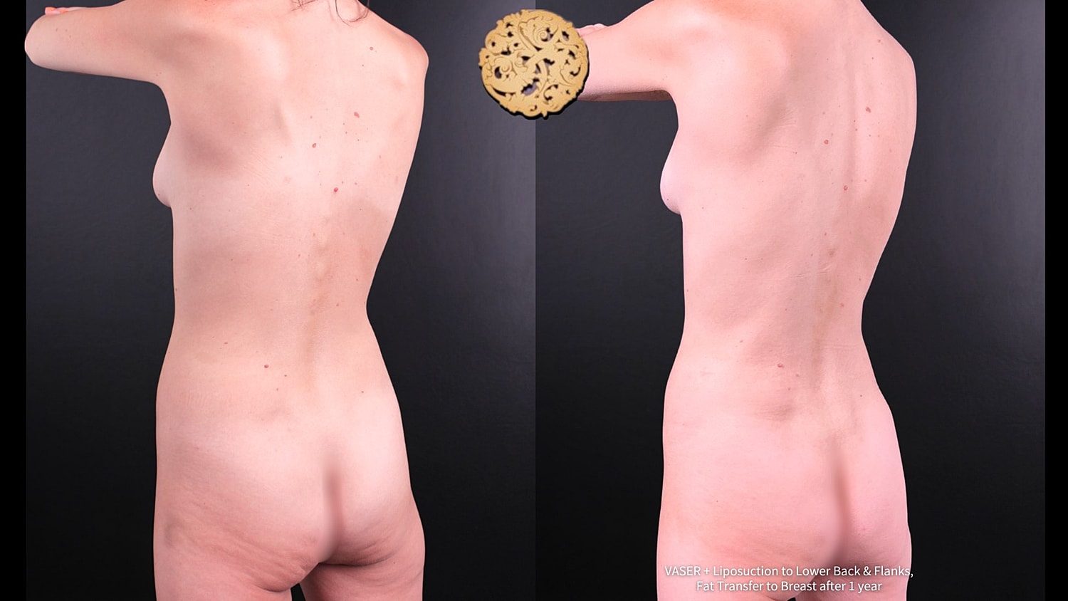 Liposuction Before & After