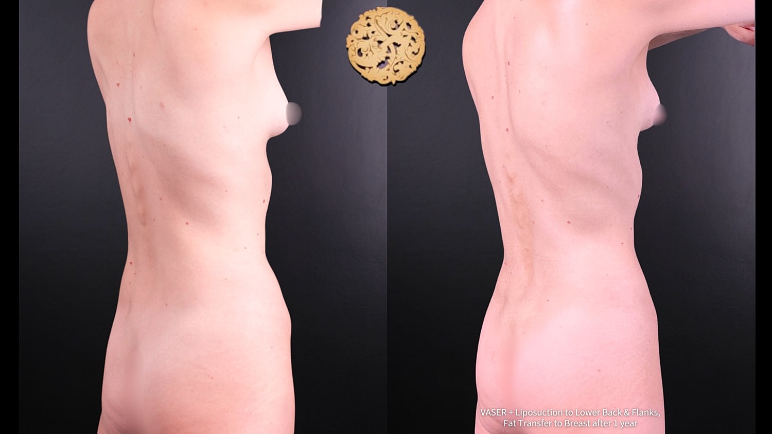 Liposuction Before & After