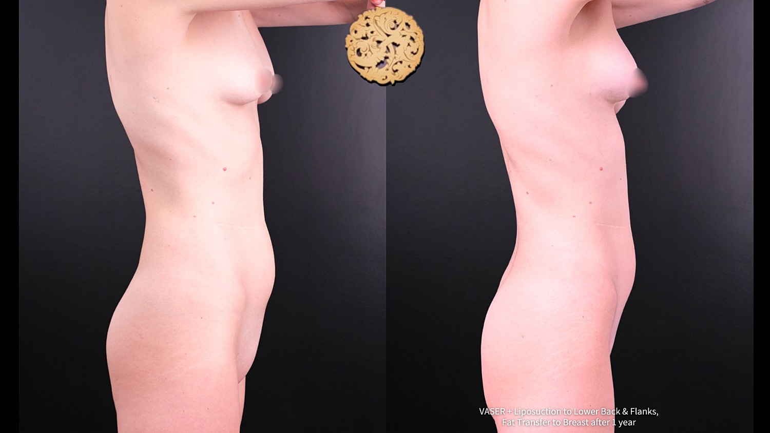 Liposuction Before & After