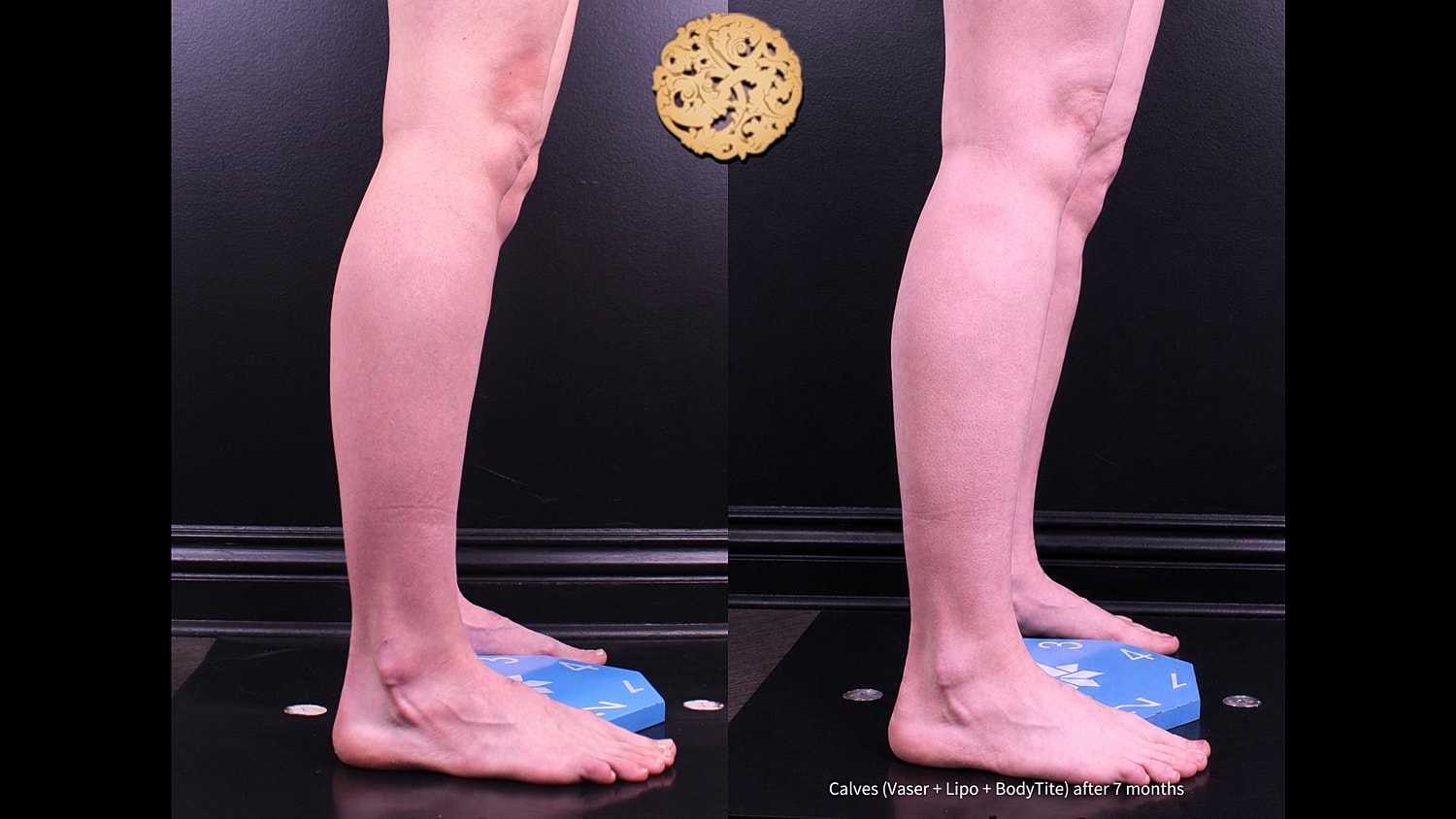 Calves ( Vaser + Lipo + BodyTite) after 7 months