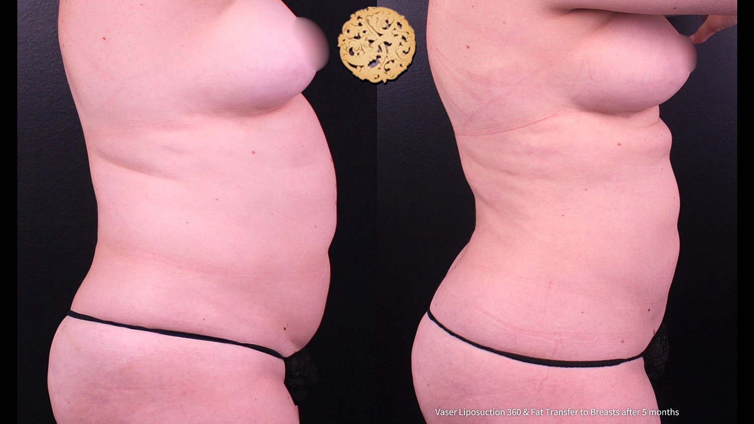 Liposuction Before & After