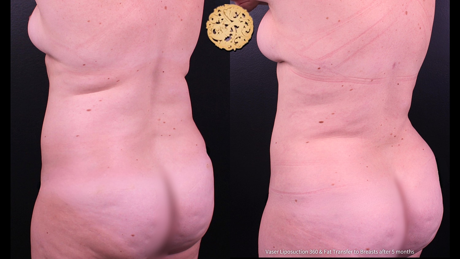 Liposuction Before & After