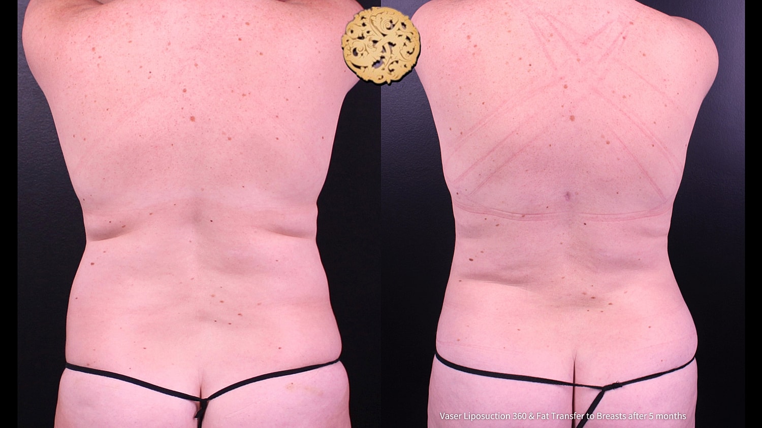 Liposuction Before & After