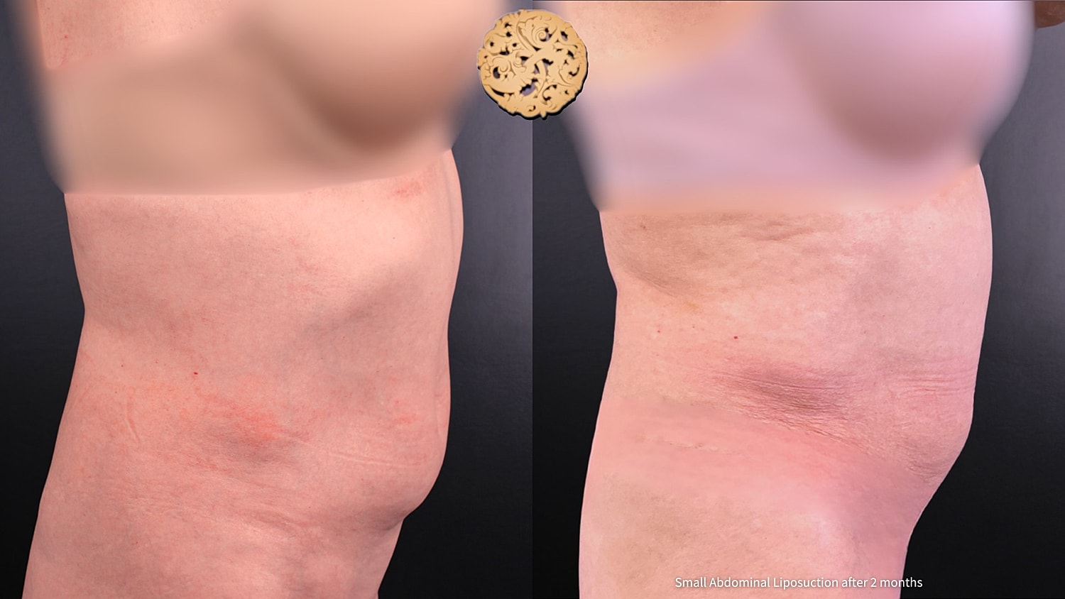 Liposuction Before & After