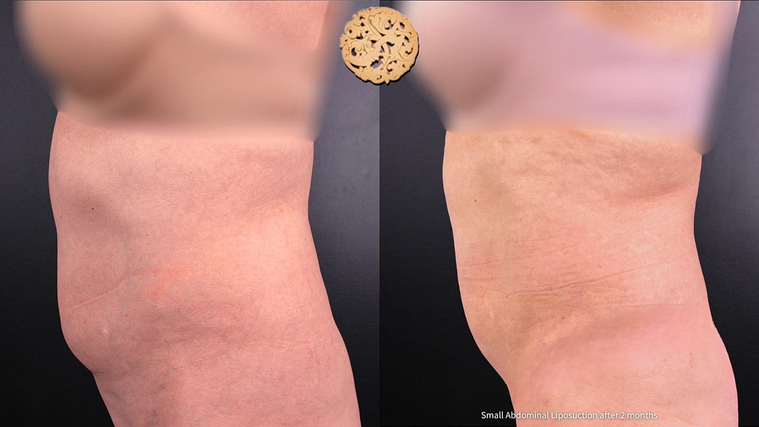 Liposuction Before & After