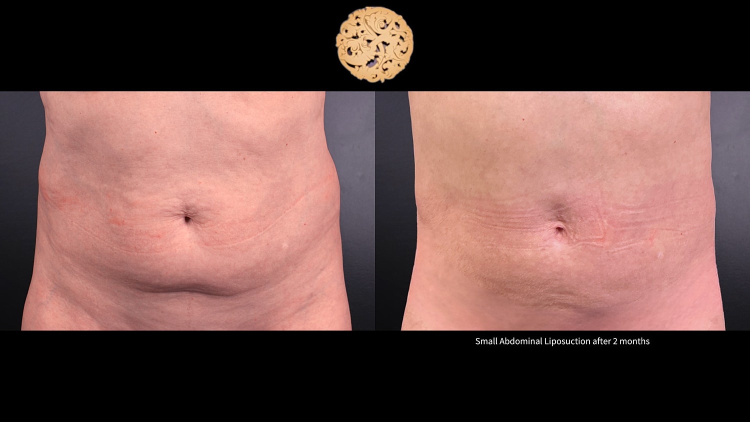 Liposuction Before & After