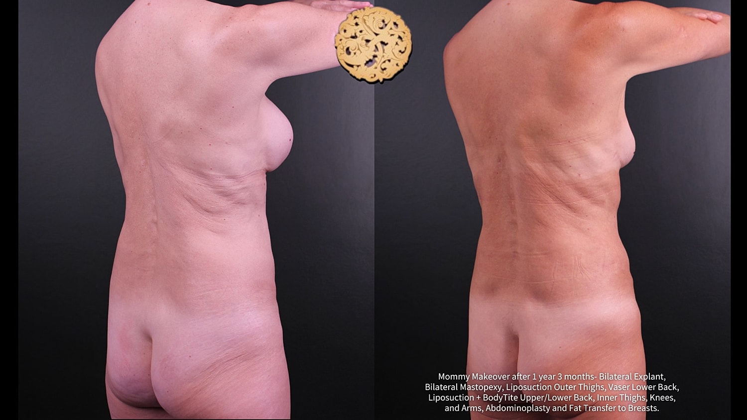 Liposuction Before & After